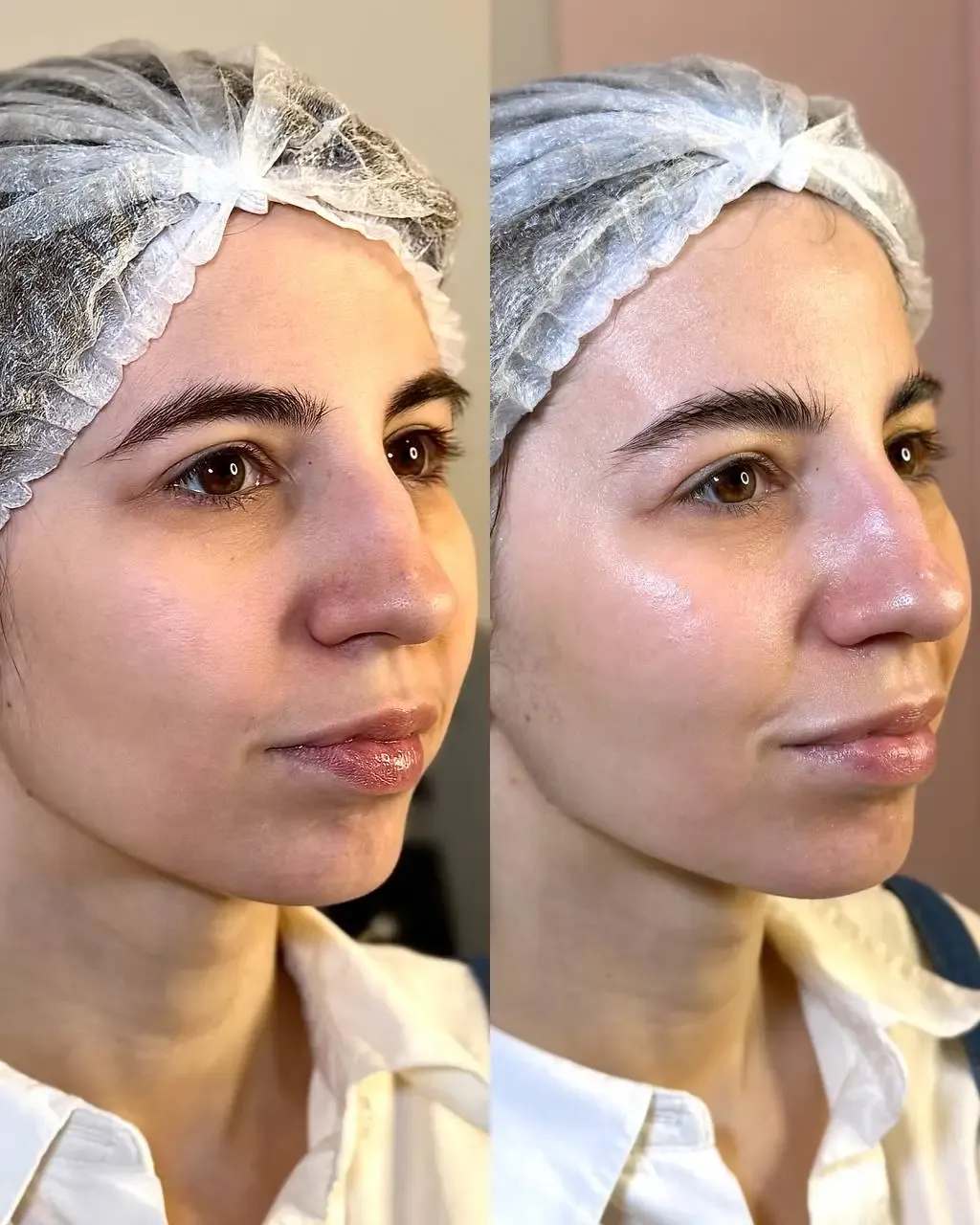 HYDRAFACIAL
