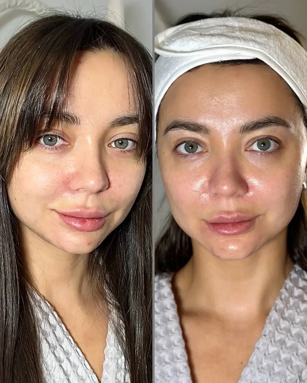 HYDRAFACIAL
