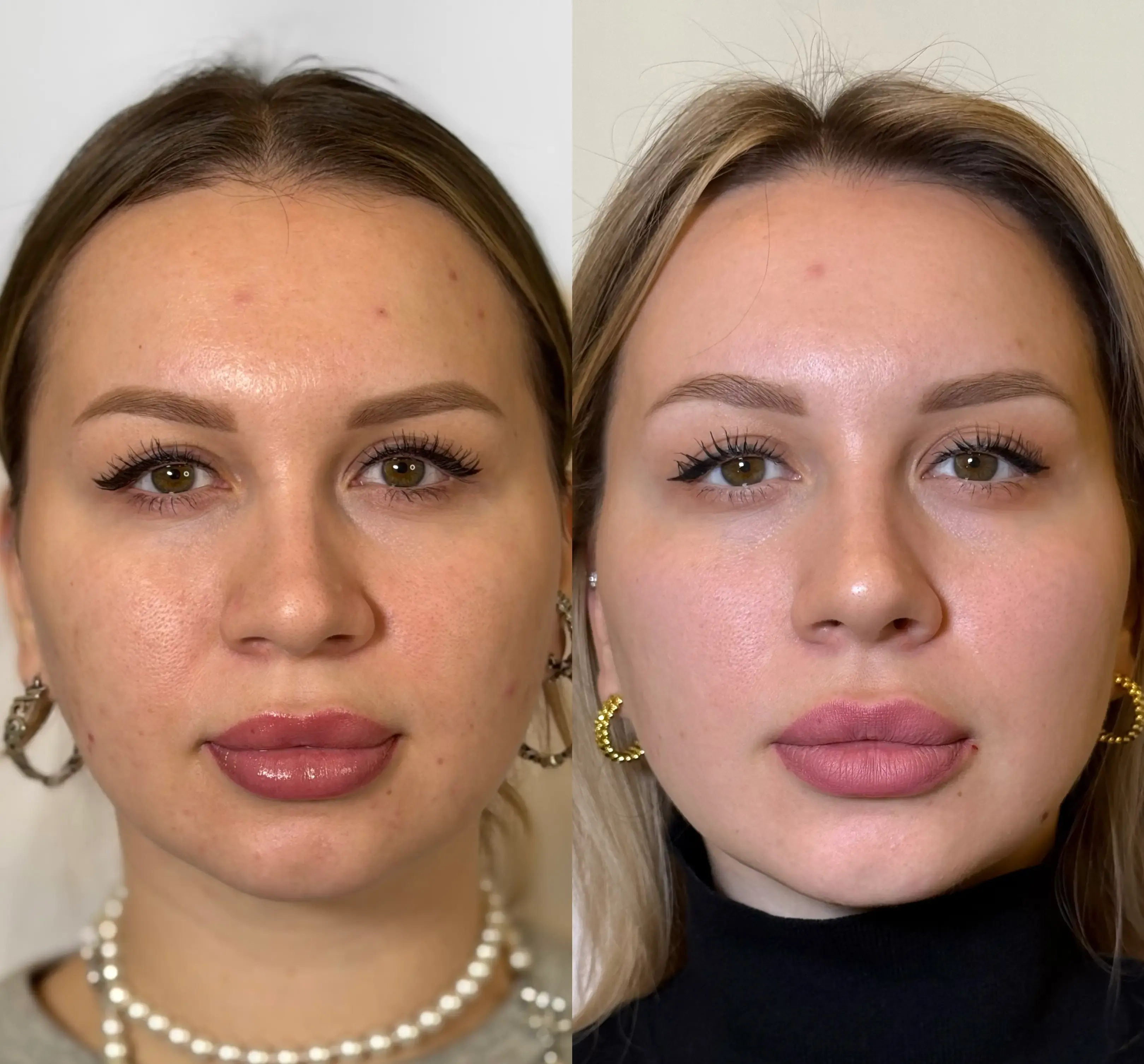 лечение акне