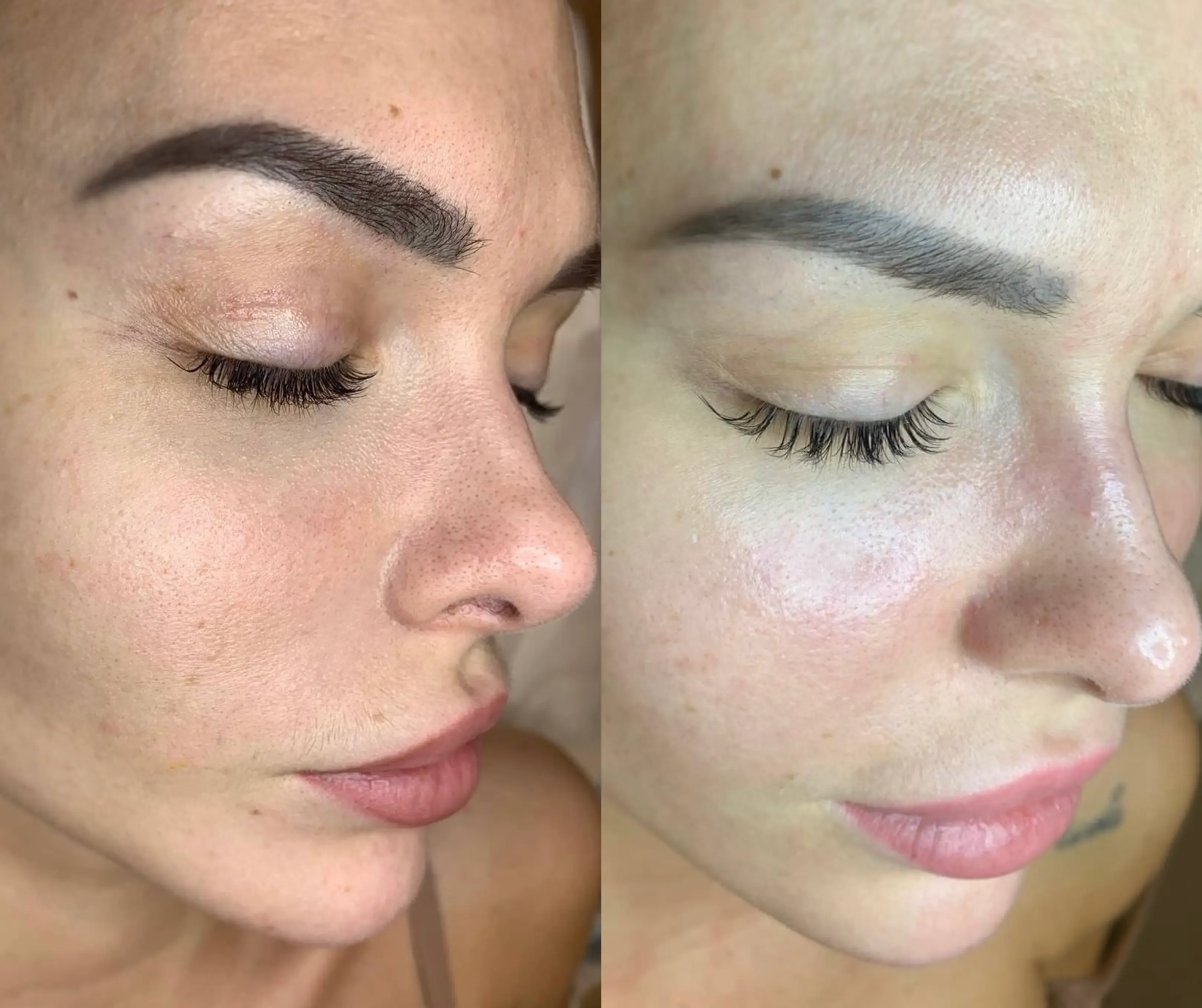 HYDRAFACIAL