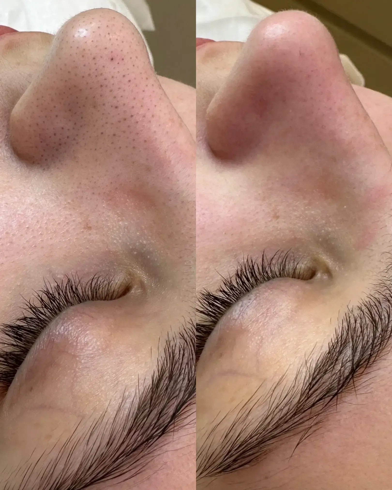 HYDRAFACIAL