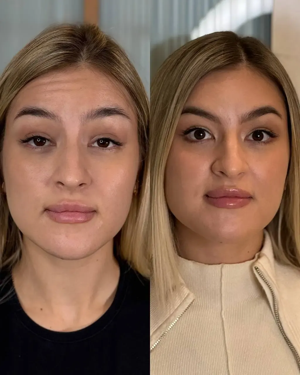 botox