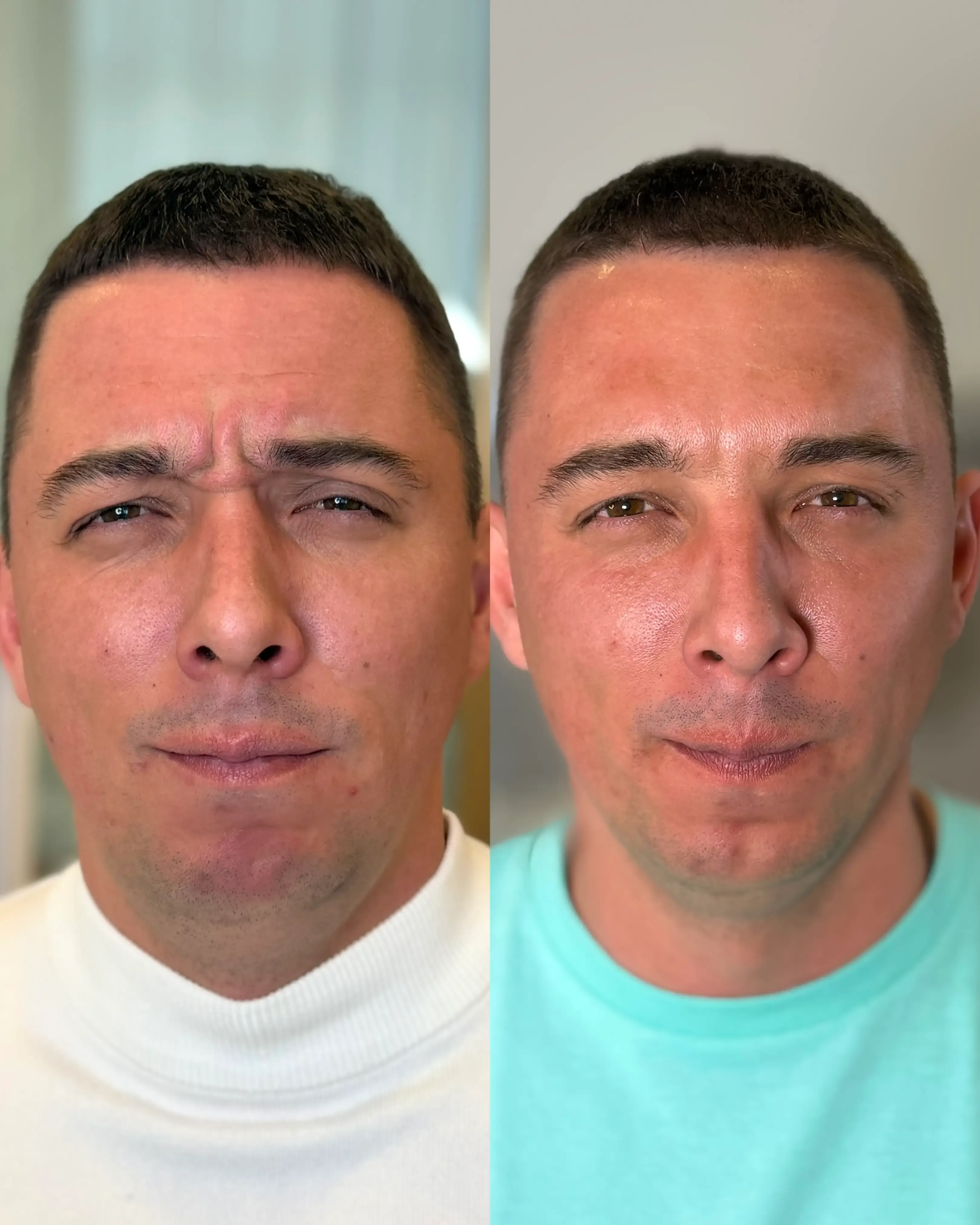 БОТОКС