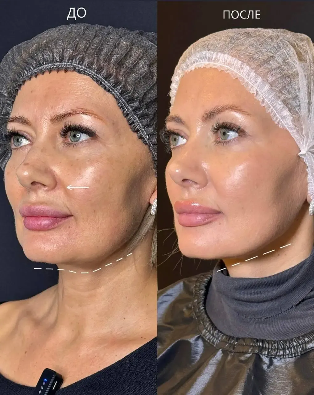 КОЛЛАГЕННОТЕРАПИЯ